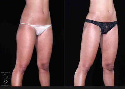 Leg and Thighs Liposuction - Before & After Photos