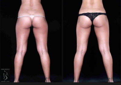Leg and Thighs Liposuction - Before & After Photos