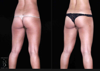 Leg and Thighs Liposuction - Before & After Photos