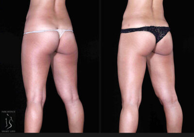 Leg and Thighs Liposuction - Before & After Photos