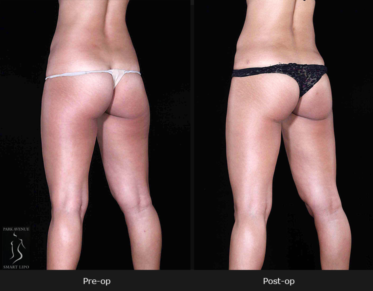 Leg and Thighs Liposuction - Before & After Photos