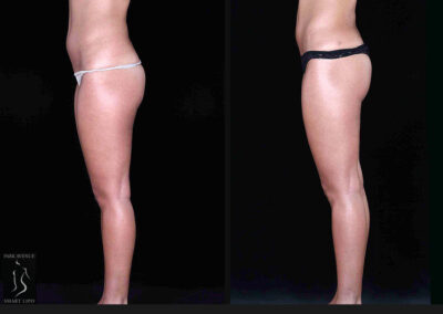 Leg and Thighs Liposuction - Before & After Photos