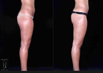 Leg and Thighs Liposuction - Before & After Photos