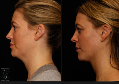 SmartLipo Neck Liposuction