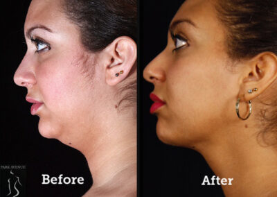 SmartLipo Neck Liposuction - Before & After Photos