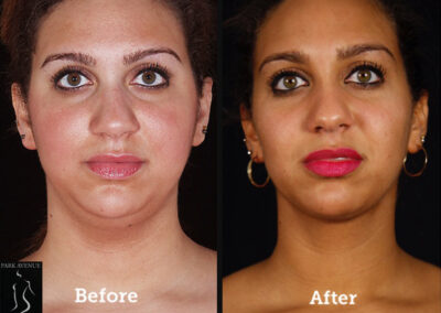 SmartLipo Neck Liposuction - Before & After Photos