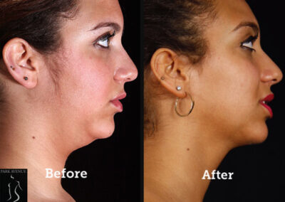 SmartLipo Neck Liposuction - Before & After Photos