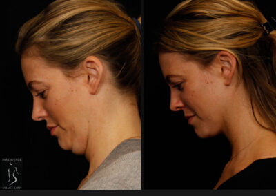 SmartLipo Neck Liposuction