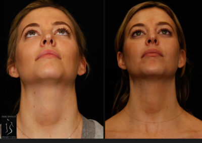 SmartLipo Neck Liposuction