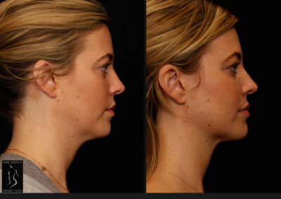 SmartLipo Neck Liposuction