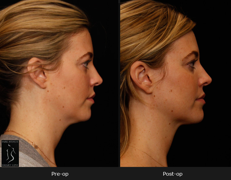 SmartLipo Neck Liposuction