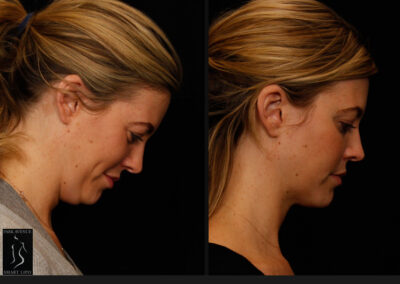 SmartLipo Neck Liposuction