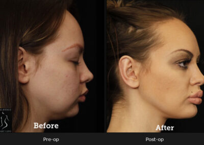 SmartLipo Neck Liposuction - Before & After Photos