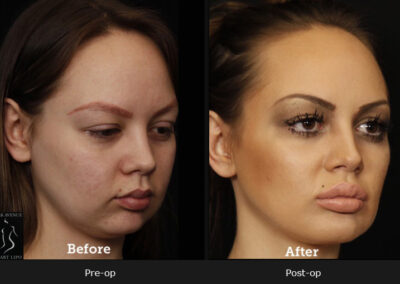 SmartLipo Neck Liposuction - Before & After Photos