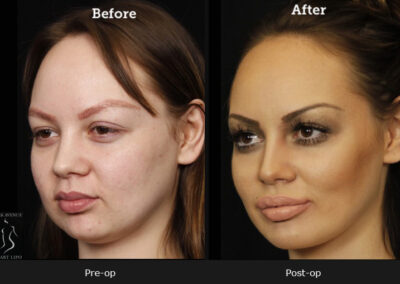 SmartLipo Neck Liposuction - Before & After Photos