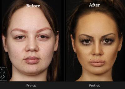 SmartLipo Neck Liposuction - Before & After Photos