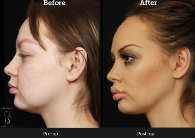 SmartLipo Neck Liposuction - Before & After Photos