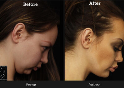 SmartLipo Neck Liposuction - Before & After Photos