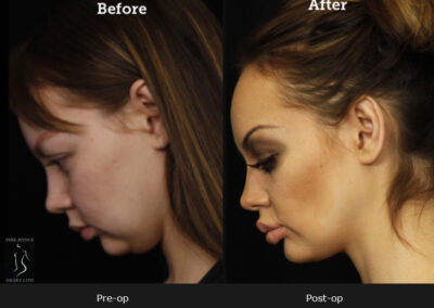 SmartLipo Neck Liposuction - Before & After Photos