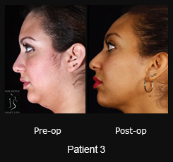 SmartLipo Neck Liposuction