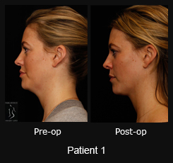 SmartLipo Neck Liposuction - Patient 1