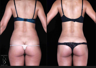 SmartLipo Flanks / Love Handles - Patient 1