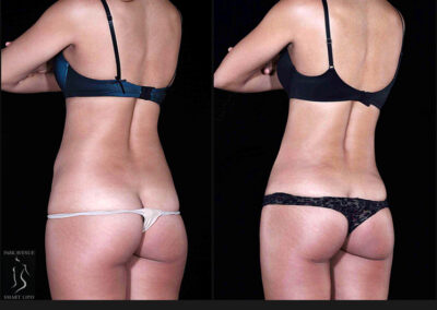 SmartLipo Flanks / Love Handles - Patient 1