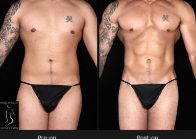 SmartLipo Abdomen - Patient 2