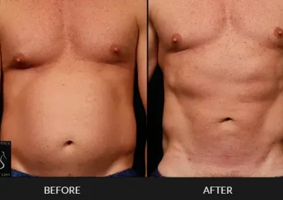 Smartlipo Abdomen Men Front