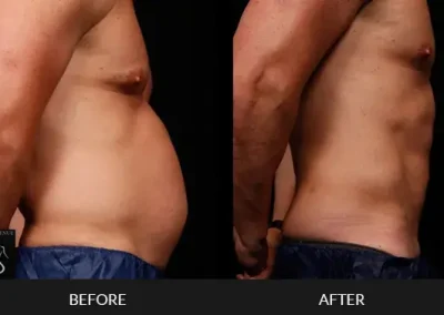 Smartlipo Abdomen Men Side