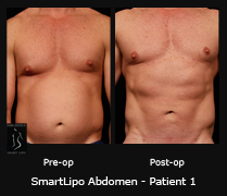 SmartLipo Abdomen - Patient 1