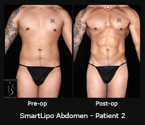 SmartLipo Abdomen - Patient 2