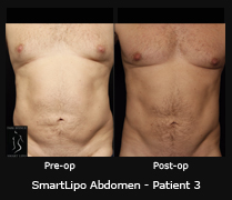 SmartLipo Abdomen - Patient 3