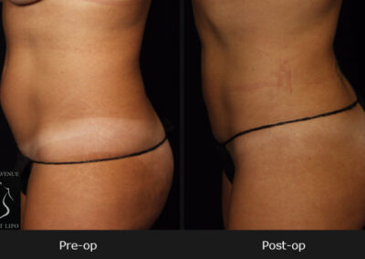 SmartLipo Abdomen - Before & After Photos