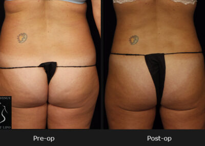 SmartLipo Abdomen - Before & After Photos