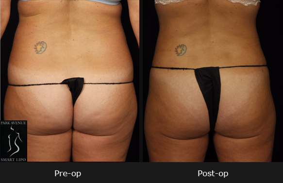 SmartLipo Abdomen - Before & After Photos