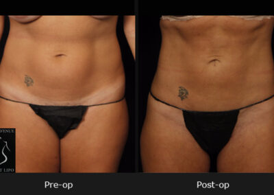 SmartLipo Abdomen - Before & After Photos