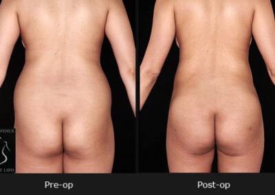 SmartLipo Flanks / Love Handles - Patient 2