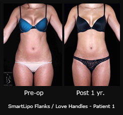 SmartLipo Flanks / Love Handles - Patient 1