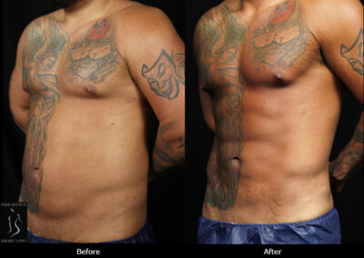 SmartLipo Love Handles - Before & After Photos