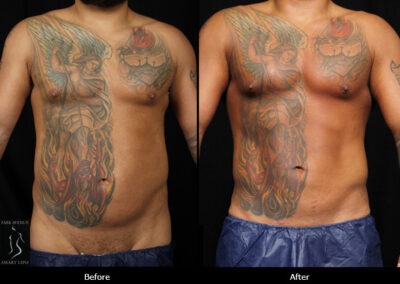 SmartLipo Love Handles - Before & After Photos