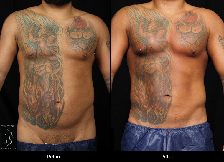 SmartLipo Love Handles - Before & After Photos