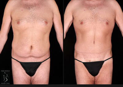 Male Tummy Tuck - Before & After Photos