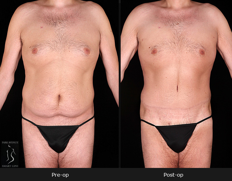 Male Tummy Tuck - Before and After Photos