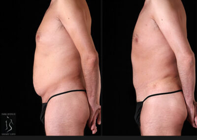 Male Tummy Tuck - Before & After Photos