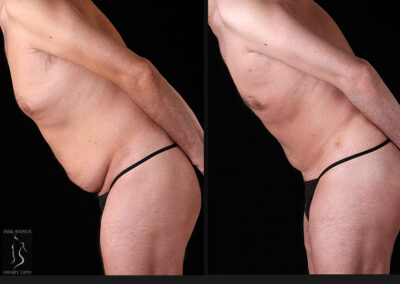 Male Tummy Tuck - Before & After Photos