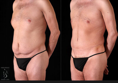 Male Tummy Tuck - Before & After Photos