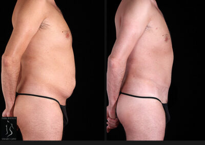 Male Tummy Tuck - Before & After Photos