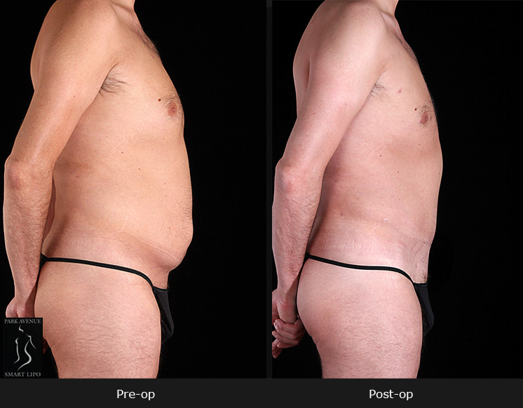 Male Tummy Tuck - Before & After Photos