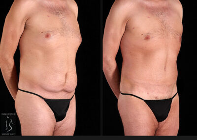 Male Tummy Tuck - Before & After Photos